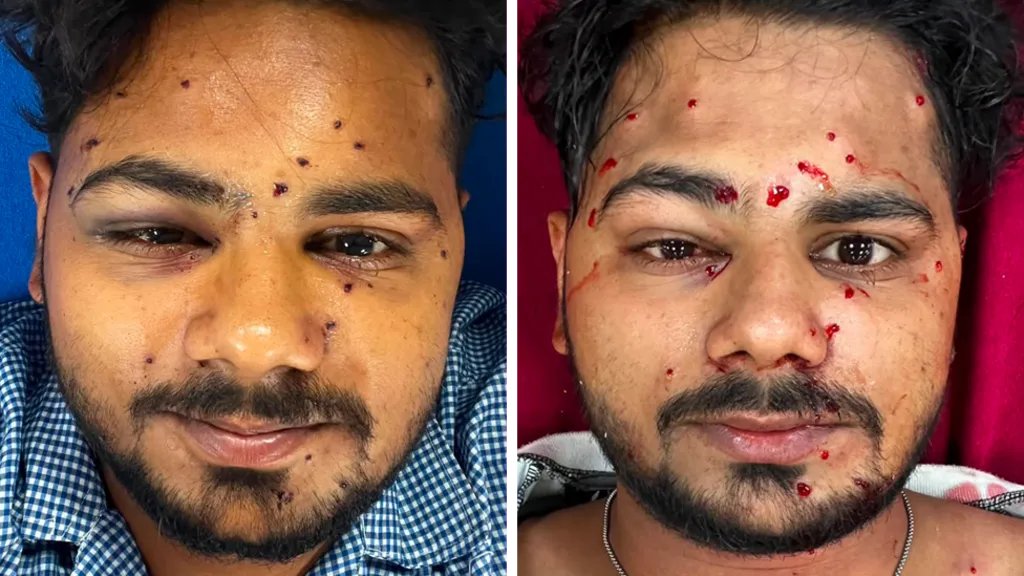إصابات متظاهر هندي خلال احتجاجات الطلاب | Injured Student Protester in India